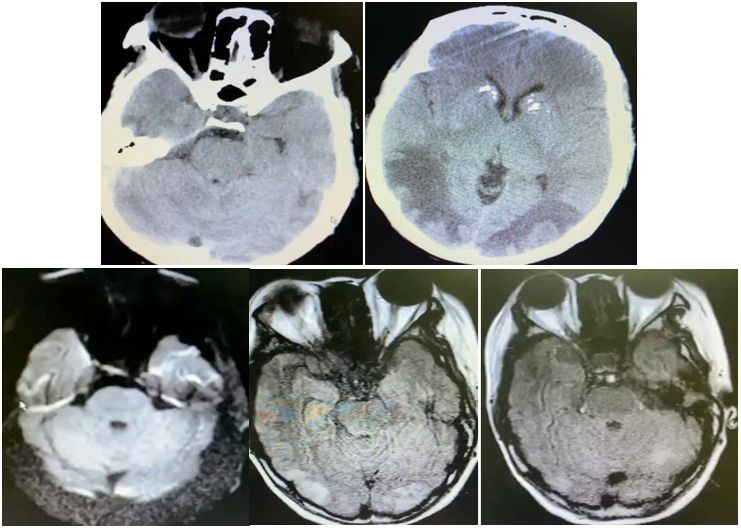 颈内动脉血栓和闭塞,颈内动脉漂浮血栓