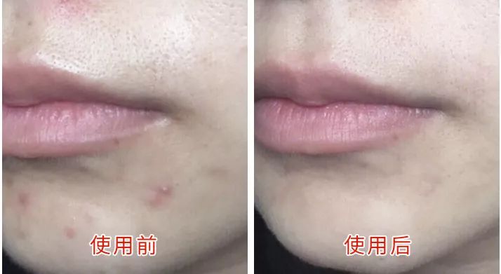 鼻头痘痘挤出来的白色物质是什么,团状红痘痘