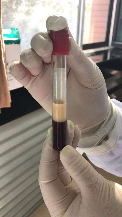 两男子因高脂血症引发胰腺炎医生以血液滤过联合血液灌流治疗已转危为安