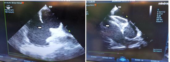 老人心脏破了个洞,高龄老人血汗管破裂能恢复吗