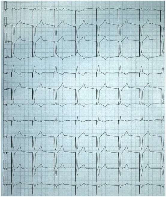 心电图显示心室起搏,心电图电极v4位置