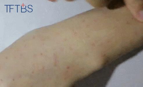 痒？给你一支“不求人”