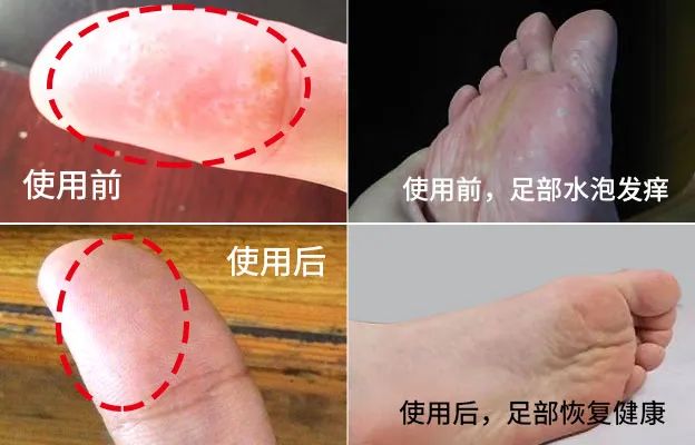 长小水泡很痒用什么中药,皮肤止痒起包用哪个药膏