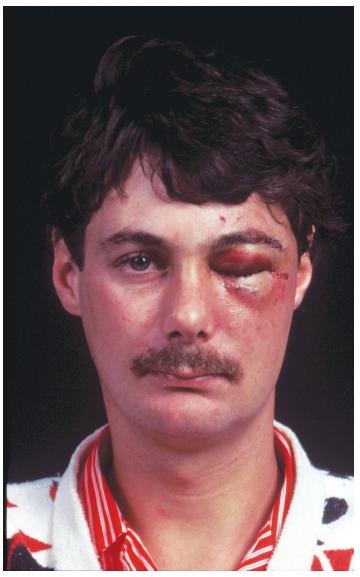 哪几处骨折最轻,头部骨折分为几种类型