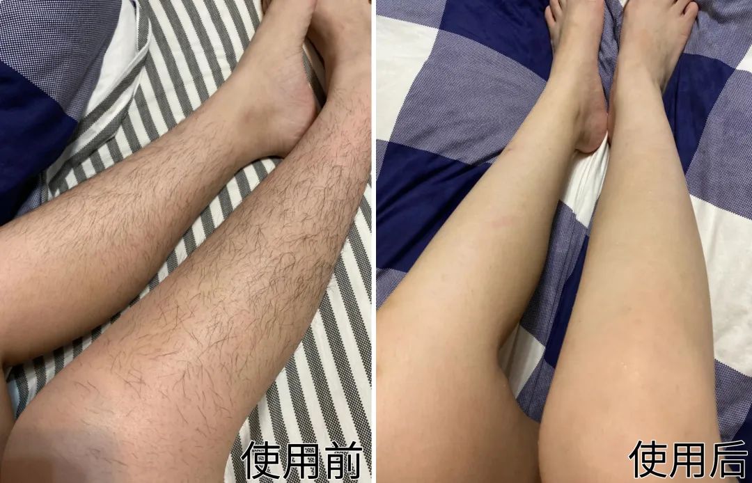 夏季脱毛用它，10分钟肌肤光滑细腻，白2度