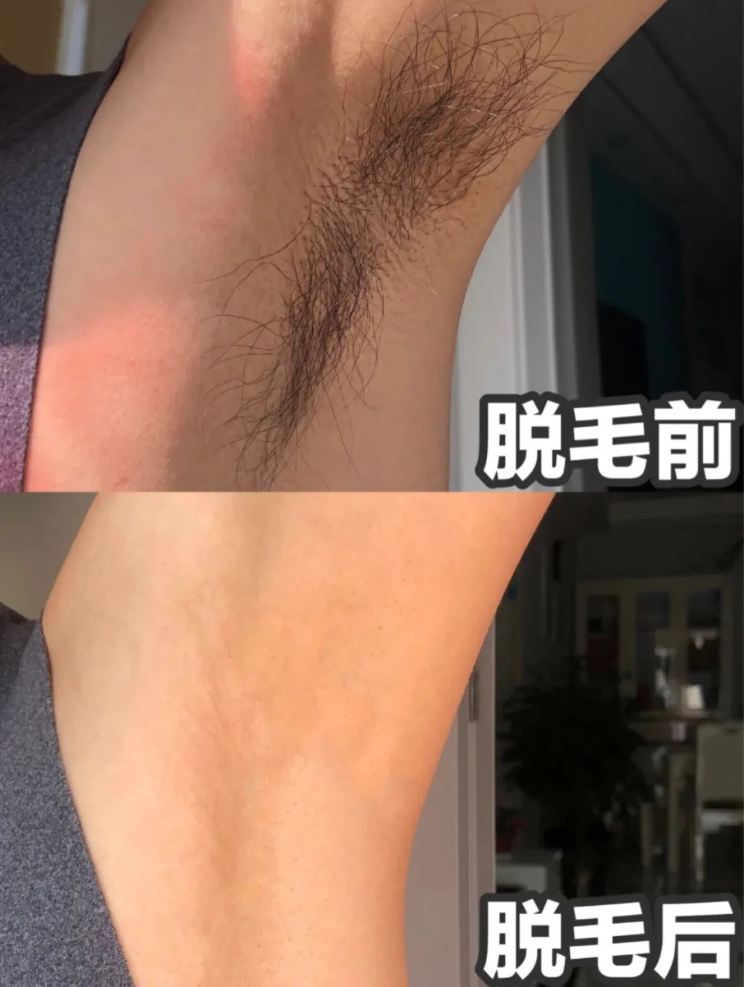 夏季脱毛用它，10分钟肌肤光滑细腻，白2度