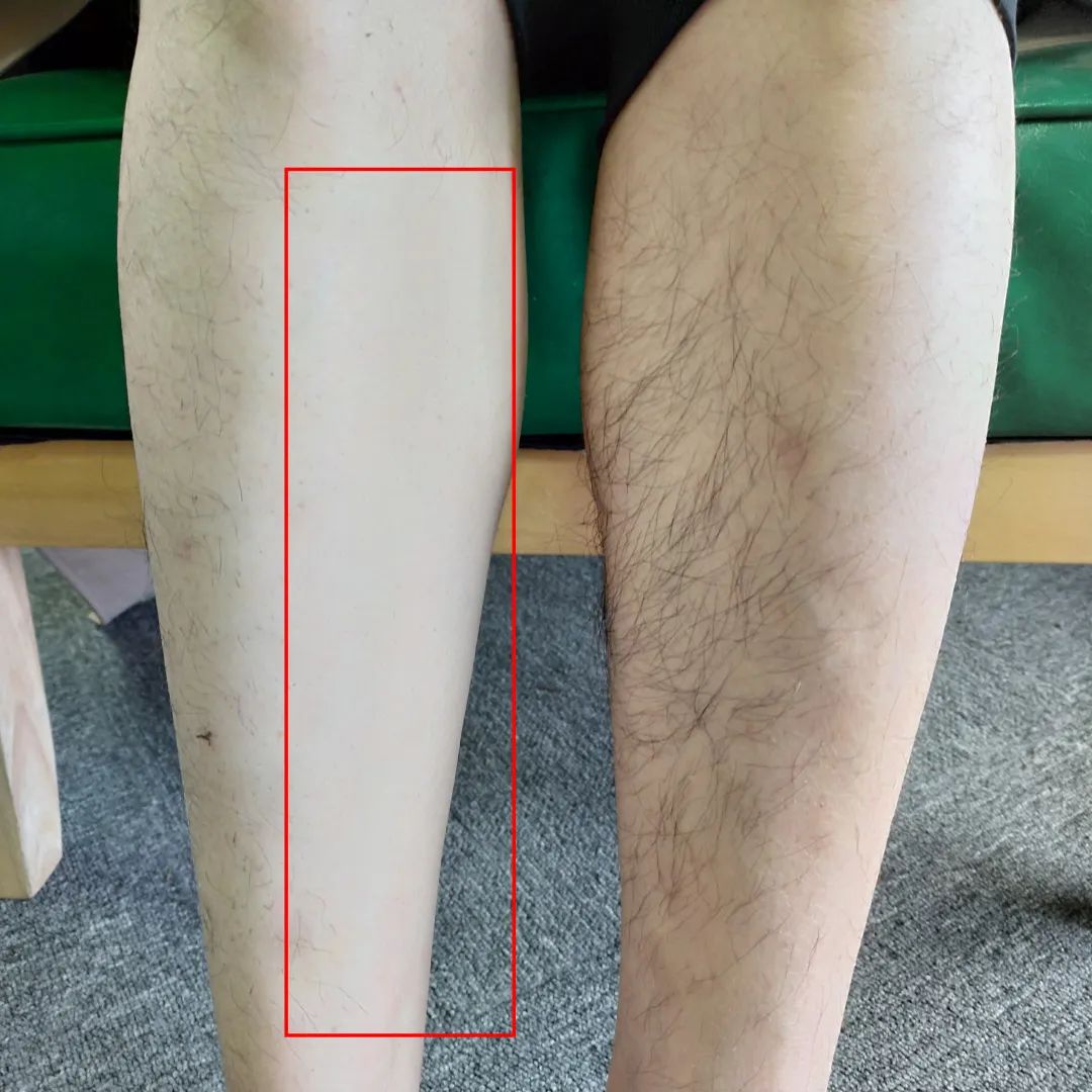 夏季脱毛用它，10分钟肌肤光滑细腻，白2度