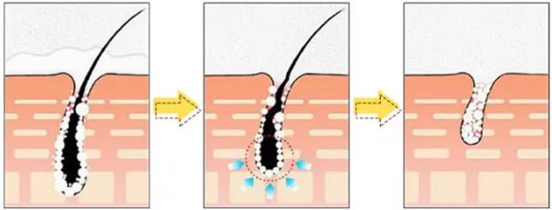 夏季脱毛用它，10分钟肌肤光滑细腻，白2度
