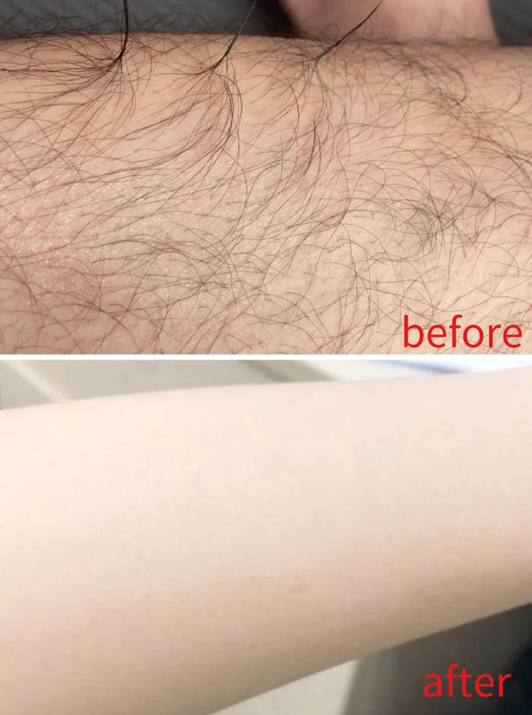 夏季脱毛用它，10分钟肌肤光滑细腻，白2度