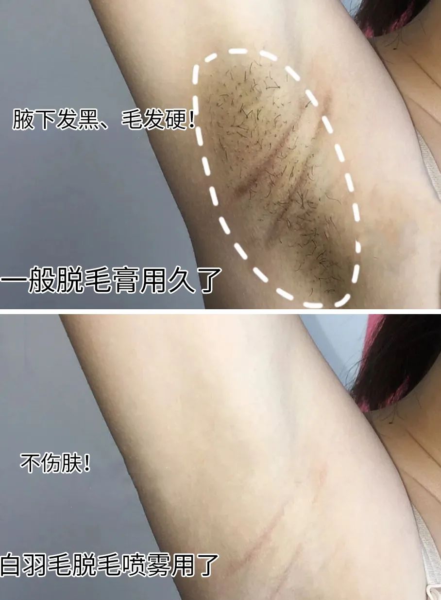 夏季脱毛用它，10分钟肌肤光滑细腻，白2度