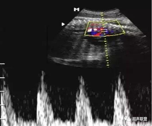 胎儿宫内窘迫如何判断,38周如何判断胎儿宫内窘迫或缺氧