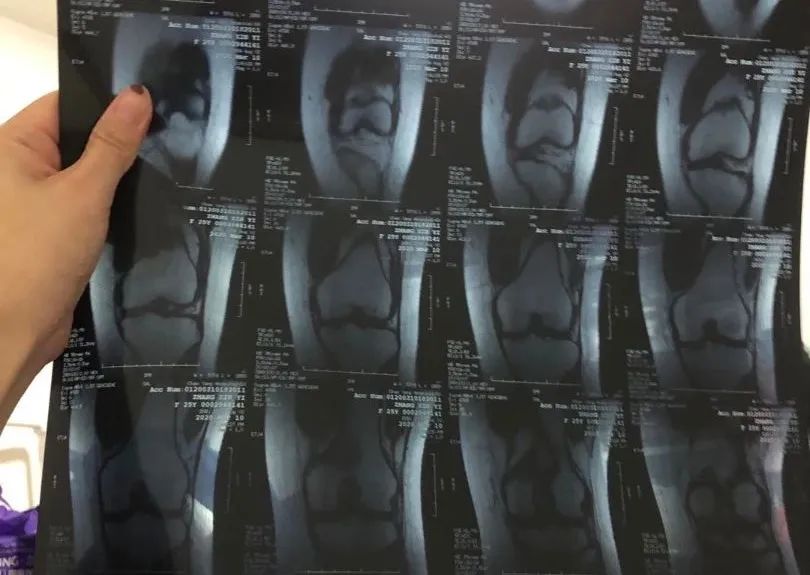 因为跳健身操，我韧带断了，花了4w做手术