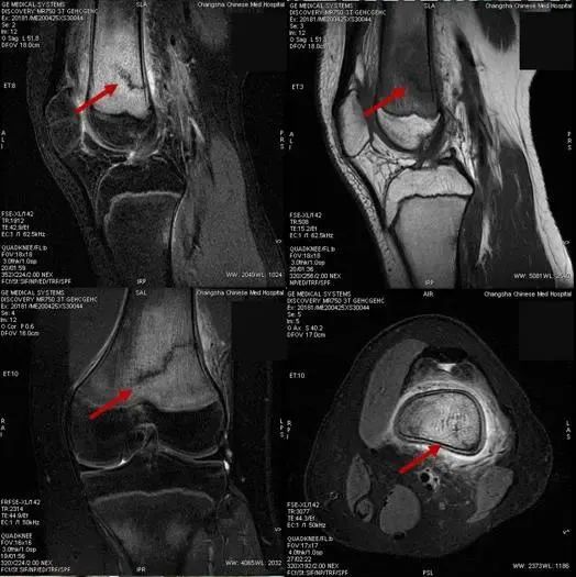 7名初中生相继骨折，都是同一原因，淄博即将开学的孩子们可要关注