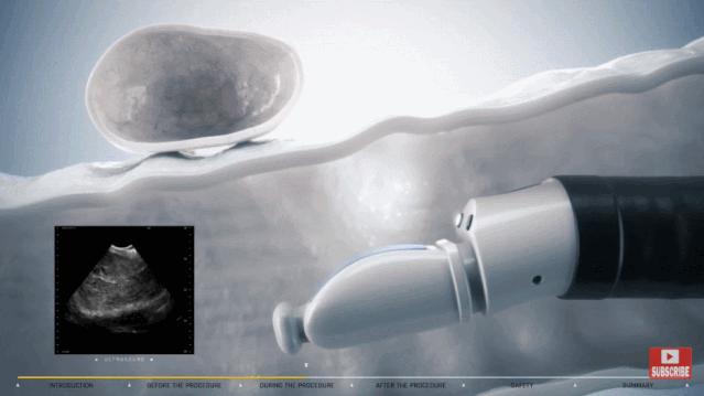 盘点医院各大科室侵入性检查：穿刺、内镜各显神通，小活检标本以“小”见“大”