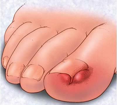 深圳一男生趾甲长进肉里了！这件事一定要从小教，否则连路都走不了