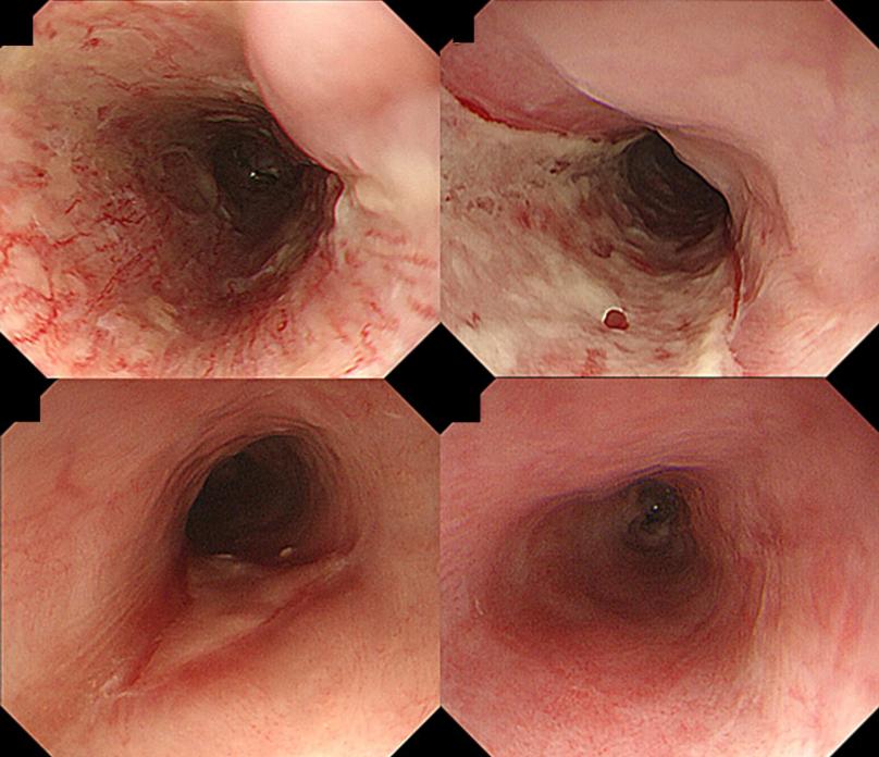 esd术后食管狭窄扩张效果,esd曲安奈德