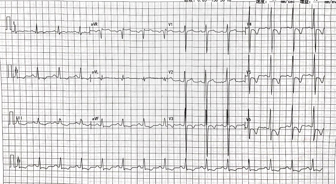 st-t改变一定就是心肌缺血吗,st-t改变是不是病理性心电图