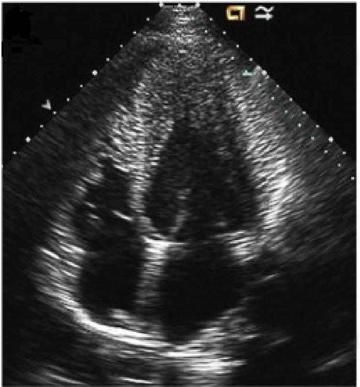 st-t改变一定就是心肌缺血吗,st-t改变是不是病理性心电图