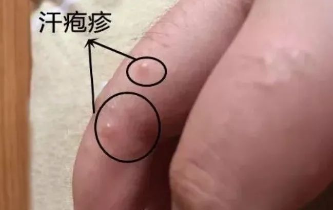 湿疹汗疱疹要关注什么,夏季皮肤湿疹关注事项