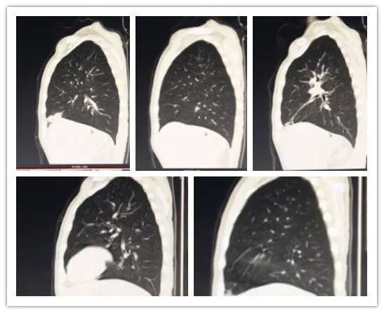 白血病浸润肺部后能治好吗,白血病浸润肝脏的超声表现