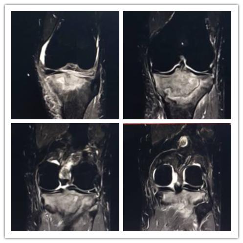 白血病浸润肺部后能治好吗,白血病浸润肝脏的超声表现