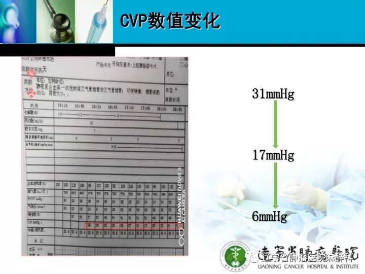 肺癌晚期上腔静脉综合征,上腔静脉综合征排期