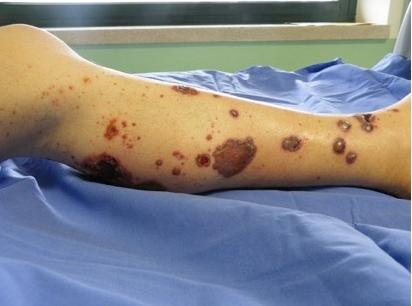 沙门氏菌感染症状的视频,易引起沙门氏菌感染症状