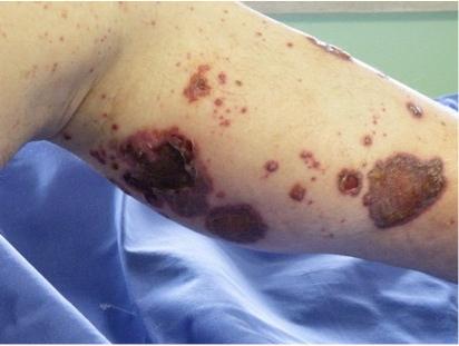 沙门氏菌感染症状的视频,易引起沙门氏菌感染症状