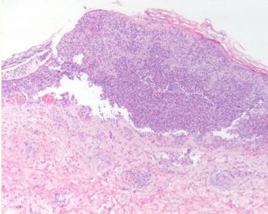 沙门氏菌感染症状的视频,易引起沙门氏菌感染症状