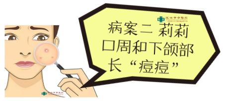 治疗青春痘中医古方也能迅速奏效,奇效火针治疗青春痘