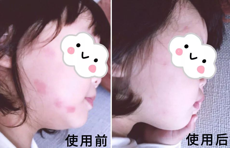 教你2分钟快速止痒,一小瓶止痒的药膏