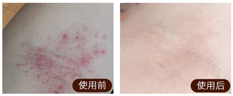 皮炎湿疹抹凡士林能抹多久,湿疹足癣用什么药膏最有效