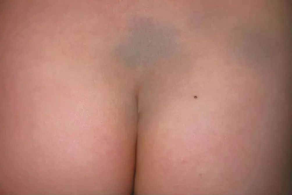 孩子身上有规则的圆形淤青,小孩鼻梁和眼睛交界处有淤青