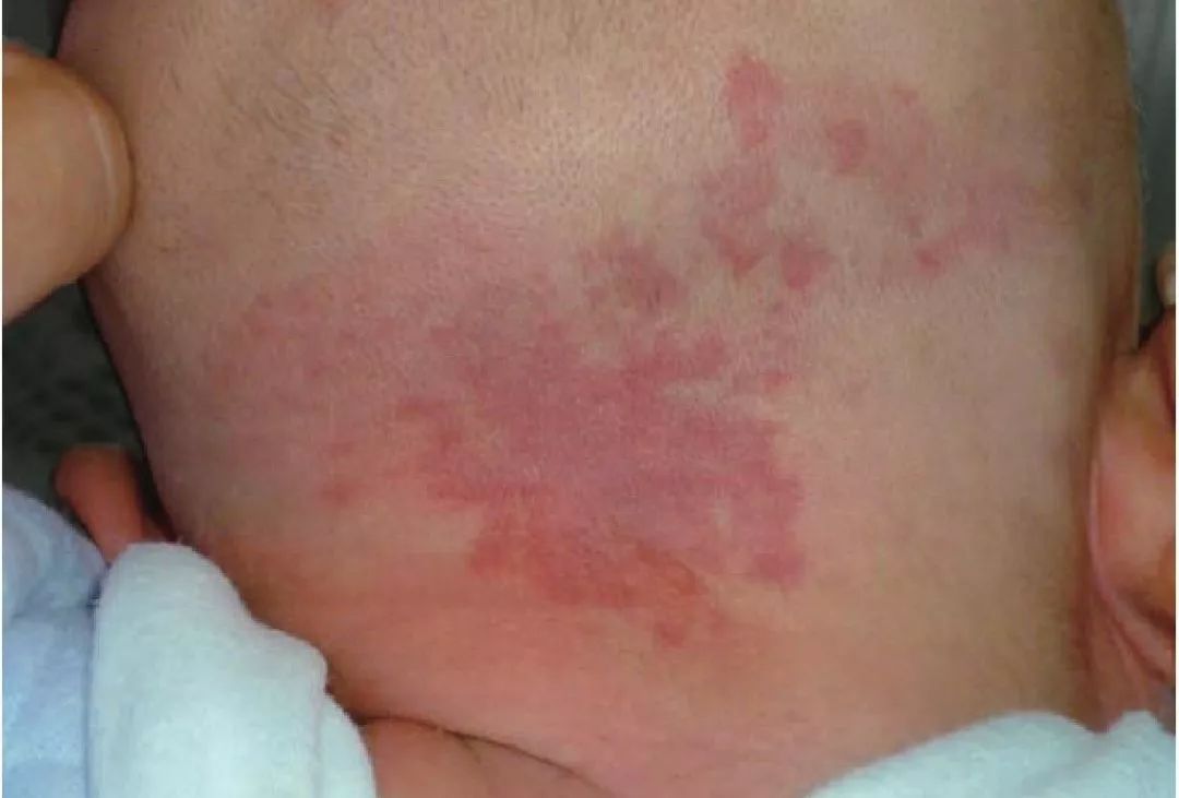 孩子身上有规则的圆形淤青,小孩鼻梁和眼睛交界处有淤青