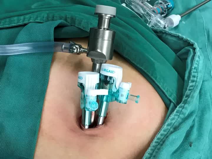 从四孔到单孔同样做手术南通王鹏主任的手术你找不到疤痕