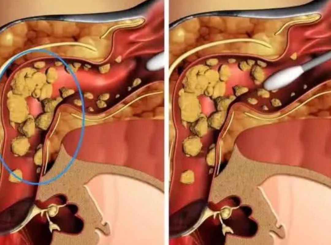 棉签抠耳朵导致癫痫,用棉签掏耳朵不谨慎被撞了一下