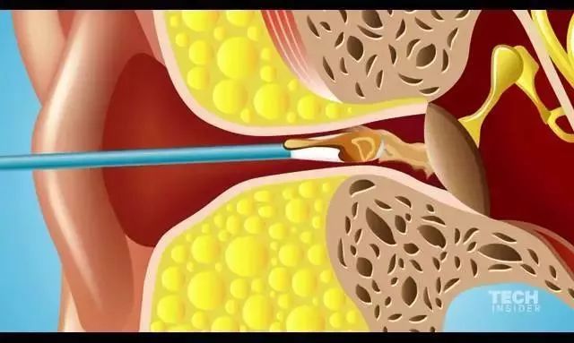 棉签抠耳朵导致癫痫,用棉签掏耳朵不谨慎被撞了一下