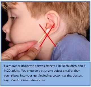 棉签抠耳朵导致癫痫,用棉签掏耳朵不谨慎被撞了一下