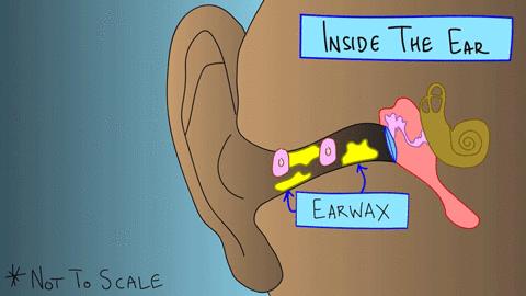 棉签抠耳朵导致癫痫,用棉签掏耳朵不谨慎被撞了一下