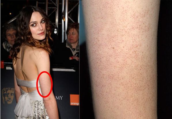 别放弃，烦人的“鸡皮疙瘩”，真的还可以再救一下