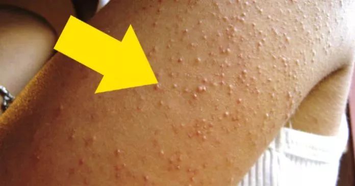 别放弃，烦人的“鸡皮疙瘩”，真的还可以再救一下