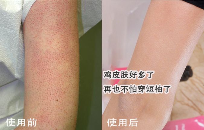 别放弃，烦人的“鸡皮疙瘩”，真的还可以再救一下