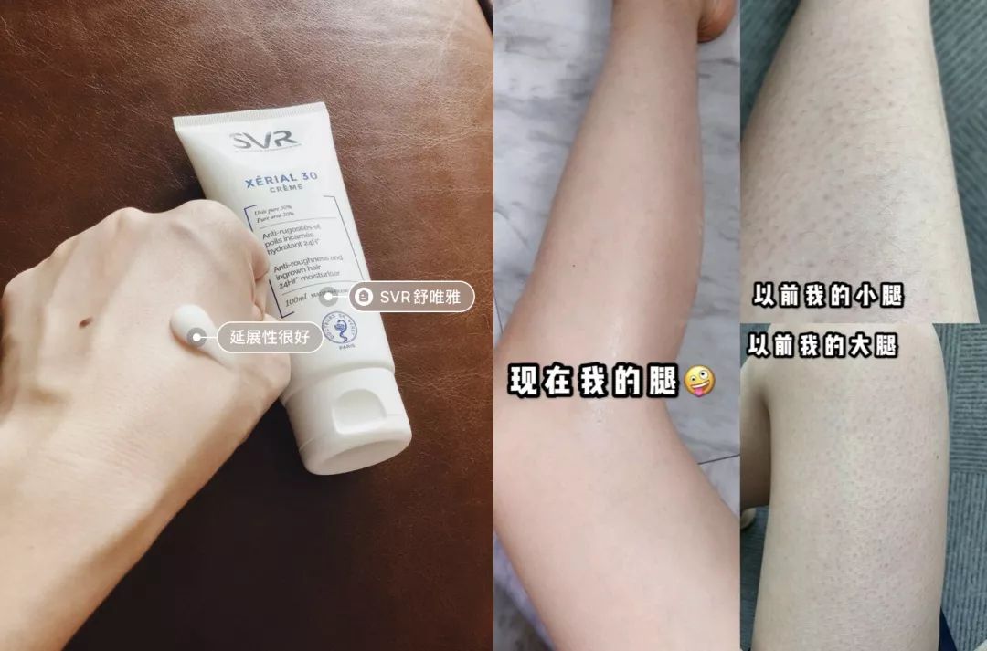 别放弃，烦人的“鸡皮疙瘩”，真的还可以再救一下