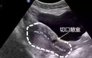 剖宫产后大姨妈来的征兆,剖宫产后一个月来大姨妈正常吗