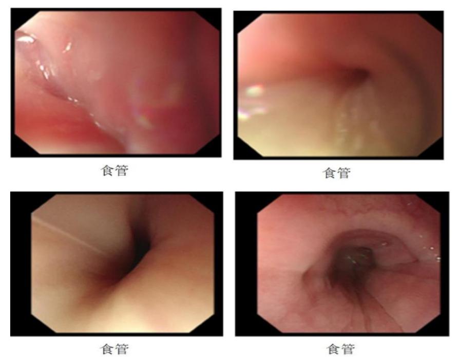 食管癌樊青霞,樊青霞讲食道癌