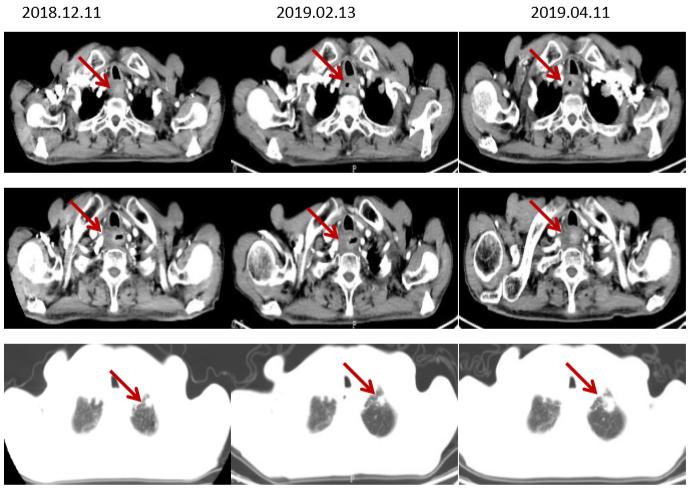 食管癌樊青霞,樊青霞讲食道癌