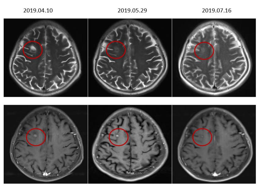 食管癌樊青霞,樊青霞讲食道癌