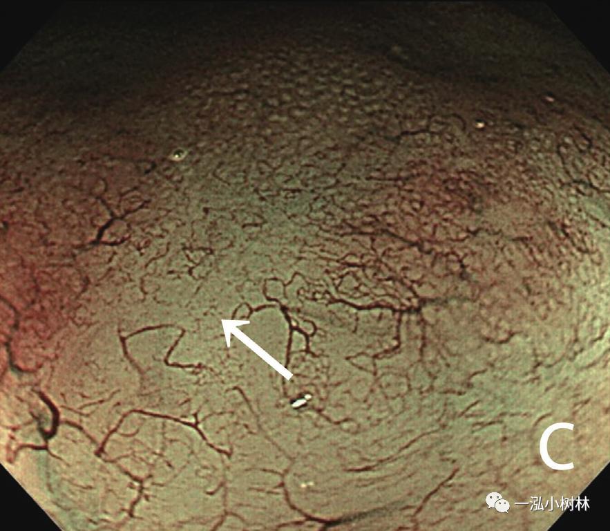 胃高级上皮内瘤变内镜案例,胃局灶性淀粉样变性预后