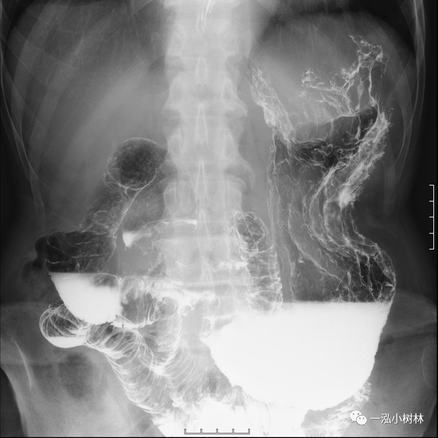 胃高级上皮内瘤变内镜案例,胃局灶性淀粉样变性预后