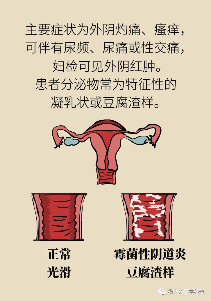 霉菌性阴道炎真的是里面“发霉”了吗？药师教你“抗霉”*法大**